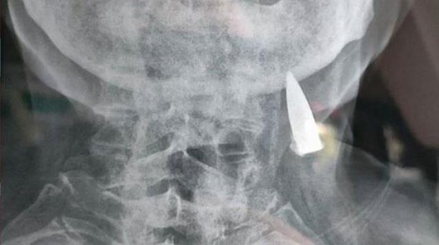 bas-agrisiyla-hastaneye-giden-95-yasindaki-adamin-15419166_4904_osd 25 yaşından onunla "ömür sürdü" - 70 il sonra üstü açıldı - FOTO