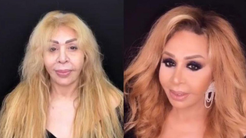 Əməkdar artist estetik əməliyyatın qurbanı oldu