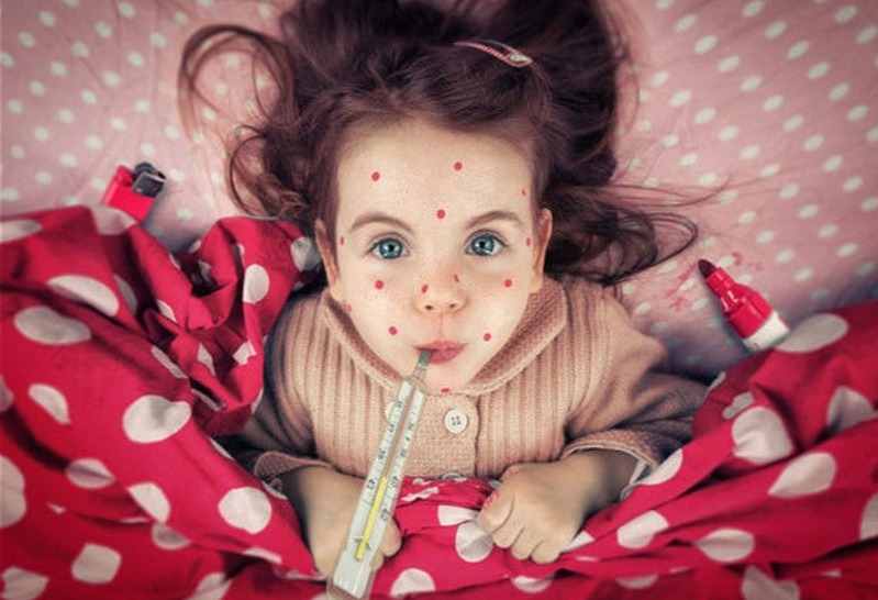 Vəziyyət ağırlaşır: qızılca ölkəni bürüyür – Məşhur həkim çıxış yolunu göstərdi