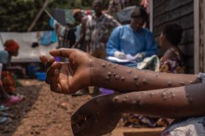 Uqandada meymunçiçəyinə yoluxma 5 minə çatır, ölənlər var