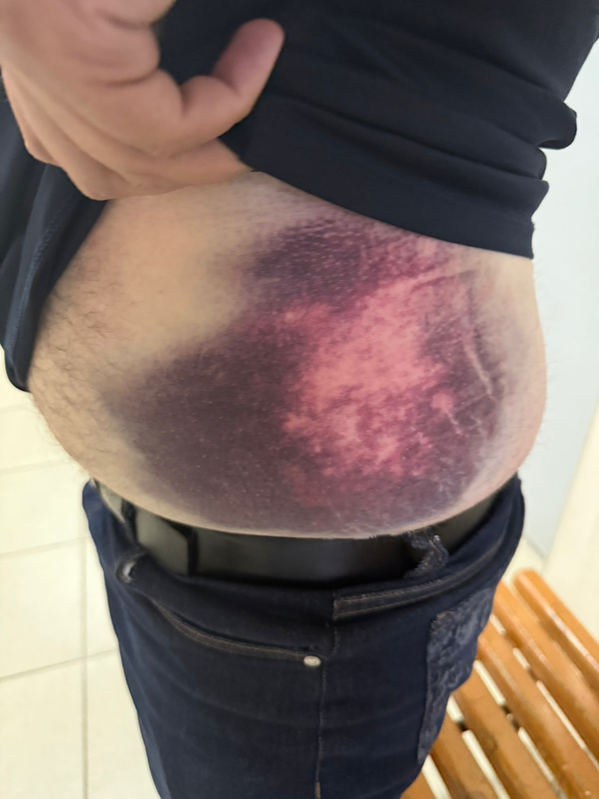 Azərbaycanlıların bədənində OMON işgəncəsinin izləri - FOTO