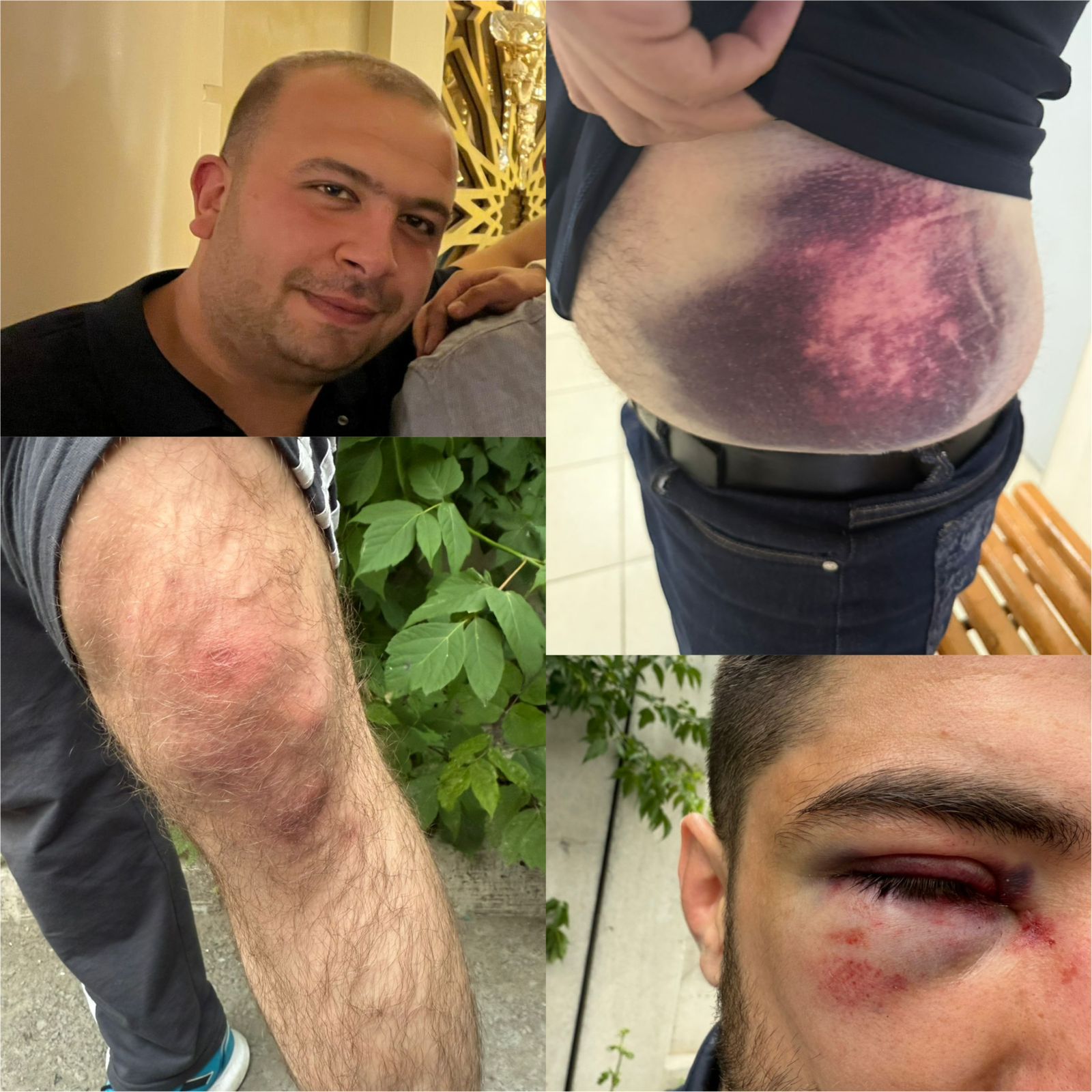 Azərbaycanlıların bədənində OMON işgəncəsinin izləri - FOTO