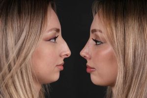 Bu qadınlara burun əməliyyatı qadağandır – SƏBƏB