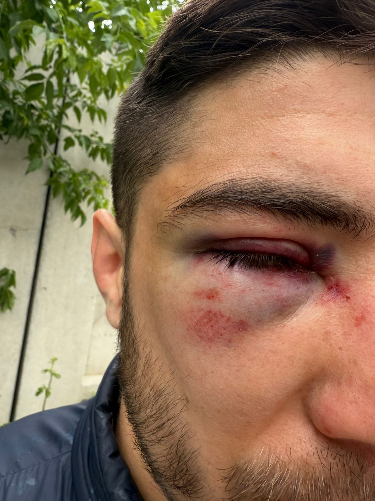 Azərbaycanlıların bədənində OMON işgəncəsinin izləri - FOTO