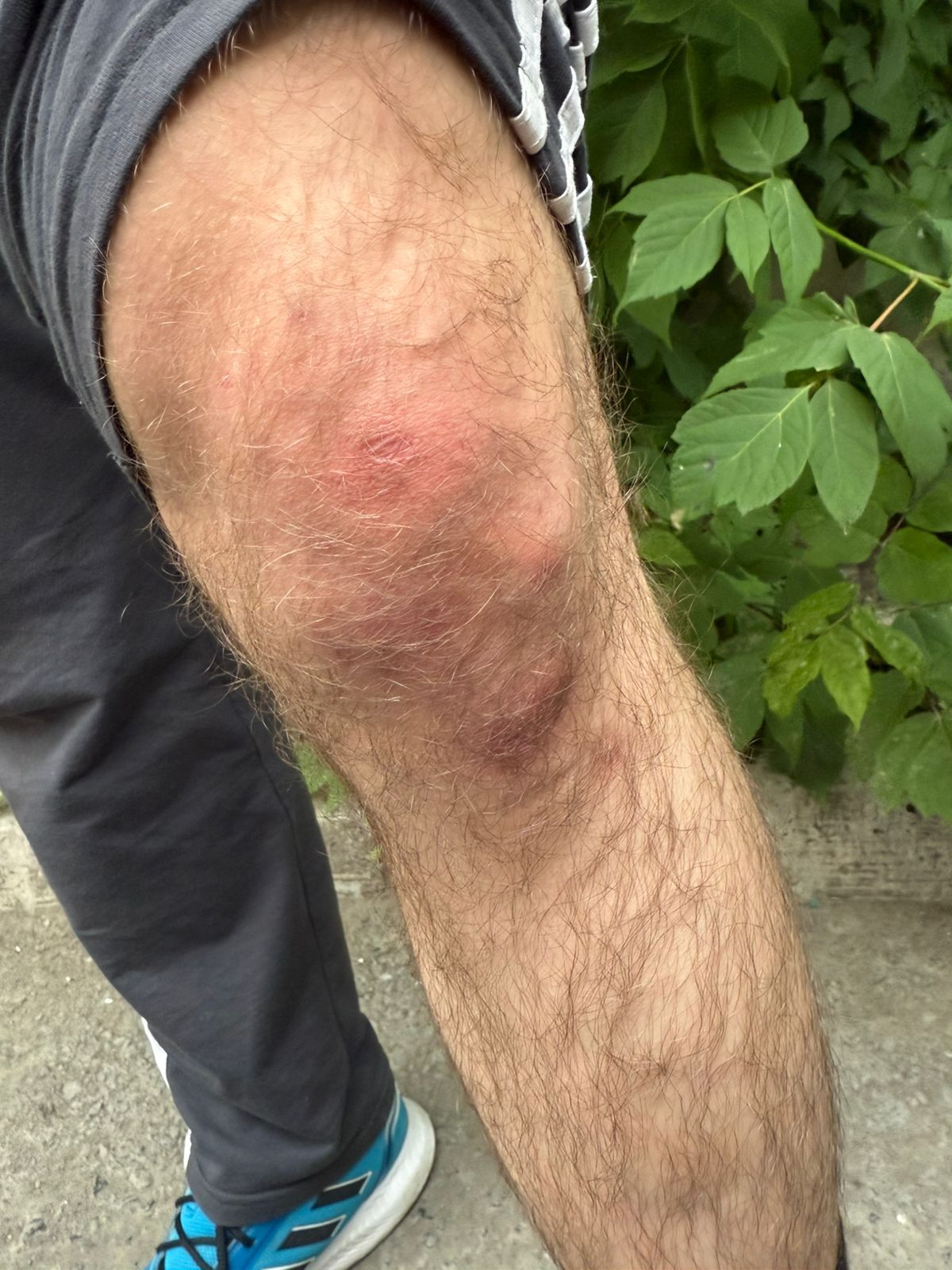 Azərbaycanlıların bədənində OMON işgəncəsinin izləri - FOTO