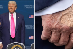 Trampın xəstəliyi məlum oldu: əlindəki ləkələr... - FOTO