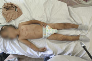 Həmin körpə süni nəfəs aparatından ayrıldı