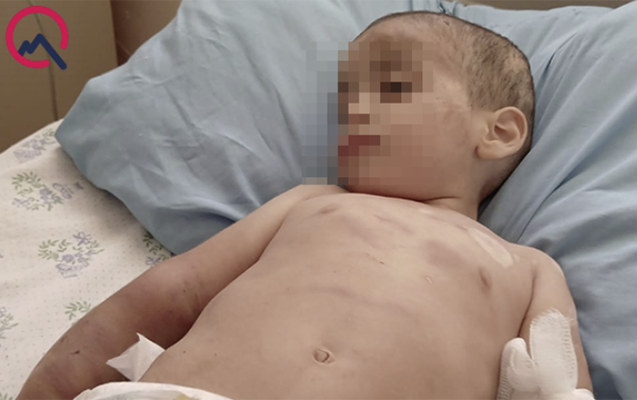 Döyülən azyaşlının vəziyyəti ağır olaraq qalır