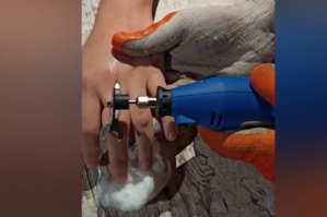 Qızın barmağında qalan üzüyü belə çıxardılar - VİDEO