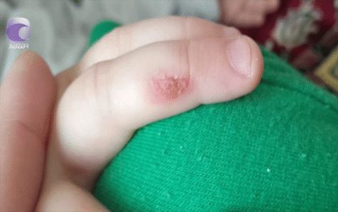 Bağça müəllimi bıçağı qızdırıb, uşağın əlinə basıb? – VİDEO