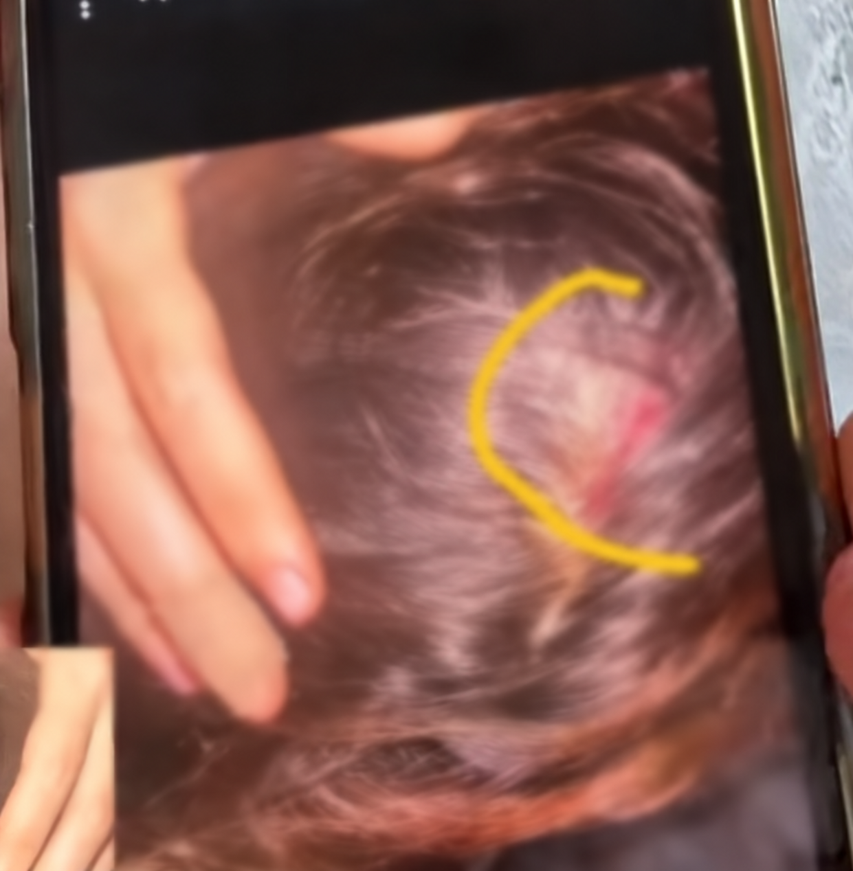 Telefon Ekraninda Vurgulanan Bas D%C9%99risi Yarasi